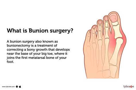 Bunion Surgery: Purpose, Procedure, Benefits and Side Effects