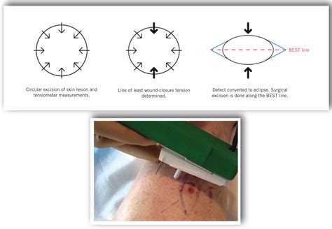 Biodynamic excisional skin tension lines for surgical excisions ...