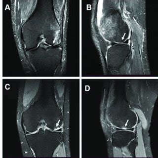 MRI images of the medial femoral condyle. (A-B) Images of cartilage... | Download Scientific Diagram