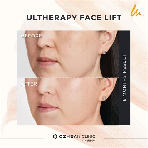 Malaysia Edition: The Undeniable Benefits of Ultherapy & Face Lifting Treatment - Ozhean