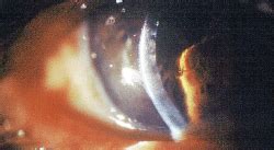 Warning: Corneal Edema Ahead