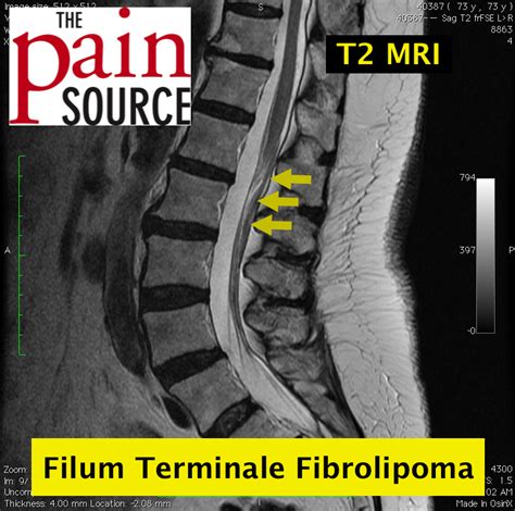 Lumbar filum terminale fibrolipoma - T2 MRI - The Pain Source