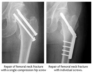 Femur Fracture Surgery Singapore| Hip Specialist Clinic