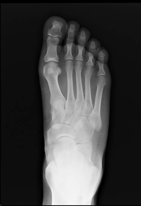 X Ray Of Foot