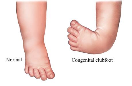 Talipes Equinovarus (Clubbed foot) ~ Anatomy for MSP