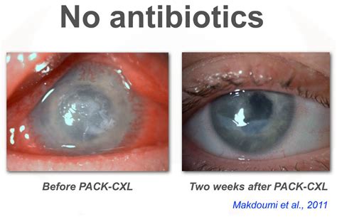 Corneal infection (PACK-CXL) - The ELZA Institute