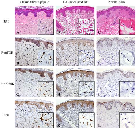 Fibrous Papule Histology