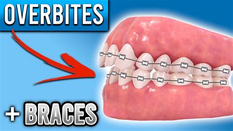 How Do BRACES FIX Overbites? | Overbite Before and After Braces | Premier Orthodontics - Dental ...