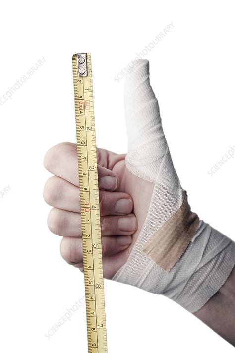 Thumb injury - Stock Image - C021/6531 - Science Photo Library