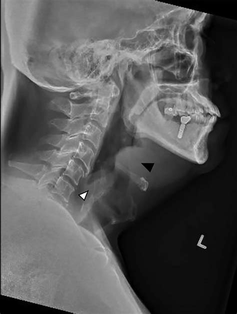 1 -Day 1: time of presentation. Lateral neck X-ray showing the double ...