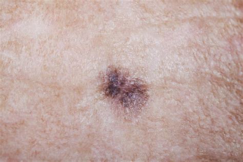 Itchy mole: Causes, treatment, and symptoms