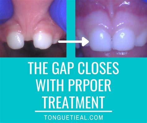 Does Treating a Lip Tie Help Close a Gap in the Teeth? And other common ...