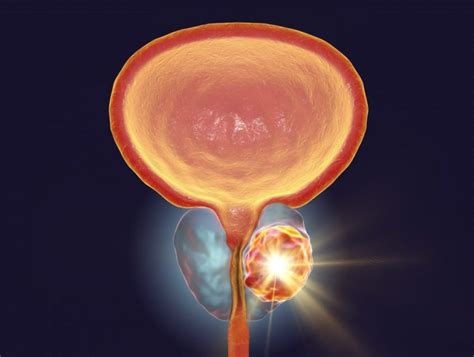 Trial to Test Focal Laser Ablation Therapy for Localized Prostate Cancer – MDSource