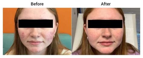 Acne Before and After Gallery - Indigo Dermatology