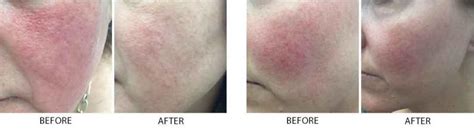 IPL for Rosacea - Bismarck, ND: Pure Skin Aesthetic & Laser Center