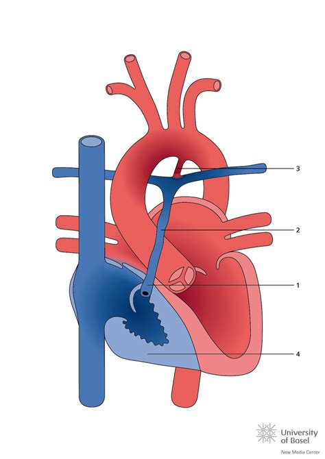 Pulmonary Atresia - Tiny Tickers