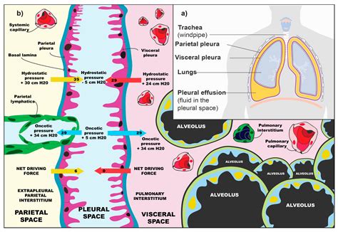 is malignant pleural effusion stage 4 - Huge Advance Chronicle Pictures Library