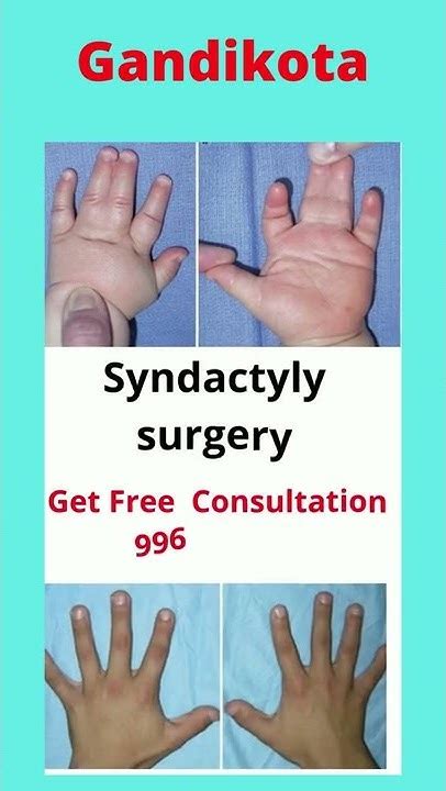 Syndactyly surgery cost in Gundikota | Syndactyly treatment in Gundikota - YouTube