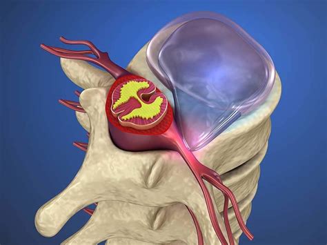 When do you know it’s time for herniated disc surgery?