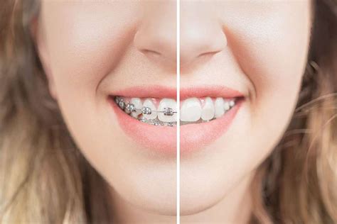 Post-Braces Maintenance: Keep Your Smile Aligned! | Gaston Orthodontics