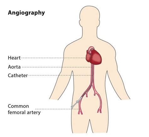 Angiography – CIRSE