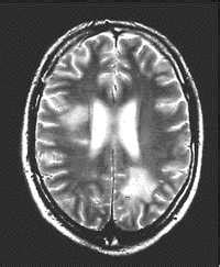 Ms Mri Brain Scan Results