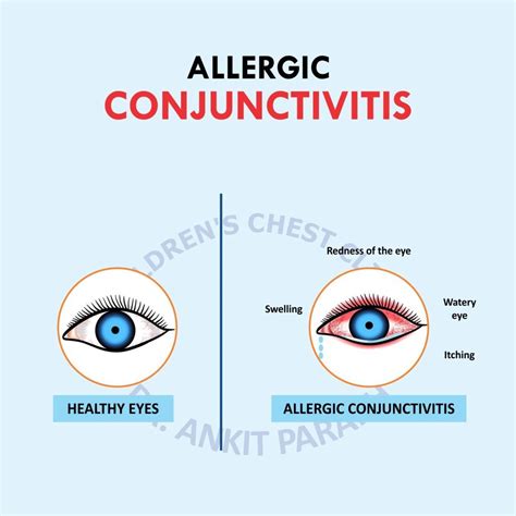 Allergic Conjunctivitis or Eye Allergy - Dr. Ankit Parakh