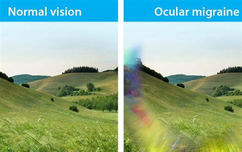 Ocular Migraine: Causes, Symptoms, Treatment | OBN