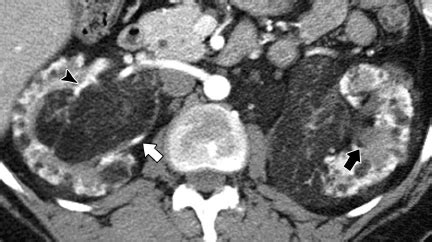 Classic angiomyolipomas in a 37-year-old woman with tuberous sclerosis.... | Download Scientific ...