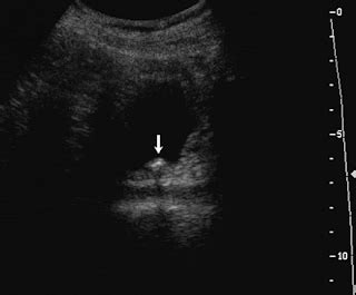 Abdominal Section: Twinkle artifact