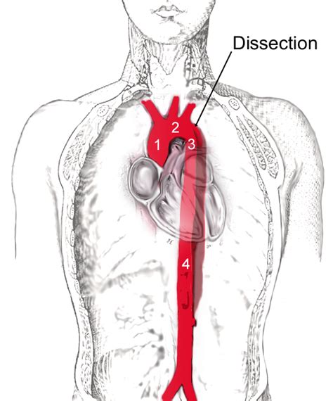 Aortic dissection - Wikipedia