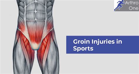 Groin Injuries in Sports – Arthro One