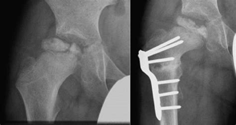 Legg–Calvé–Perthes disease of the hip - Surgery - Oxford International ...