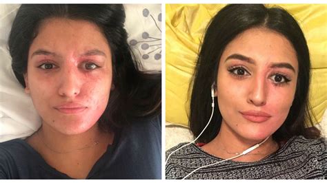 Acid Attack Survivor Posts Makeup-Free Selfie to Give Others Hope | Allure