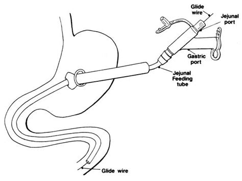 A novel technique for percutaneous endoscopic gastrojejunostomy tube placement ...