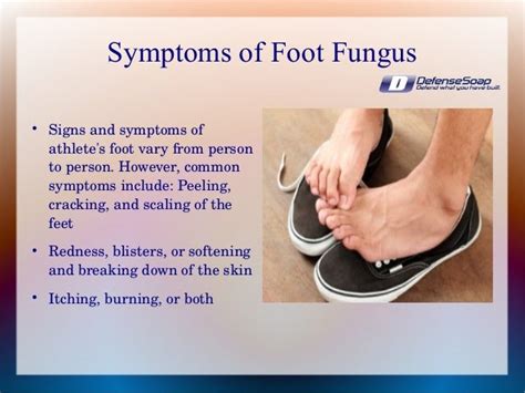 Foot Fungus in Athletes