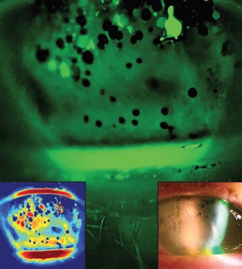 Bullous Keratopathy - Modern Optometry