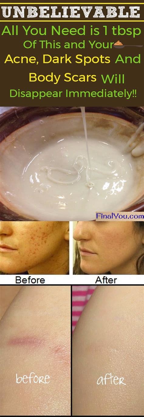 UNBELIEVABLE!! HOMEMADE FACE MASK TO GET RID OF SPOTS, ACNE SCARS, AND WRINKLES | Health DIY and ...