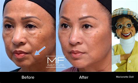 Before and After Marionette Lines Filler: A Photo FAQ | Mabrie Facial ...