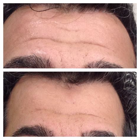 eDermaStamp® by Dermaroller® | Dermaroller® Micro-Needling | Collagen Induction Therapy