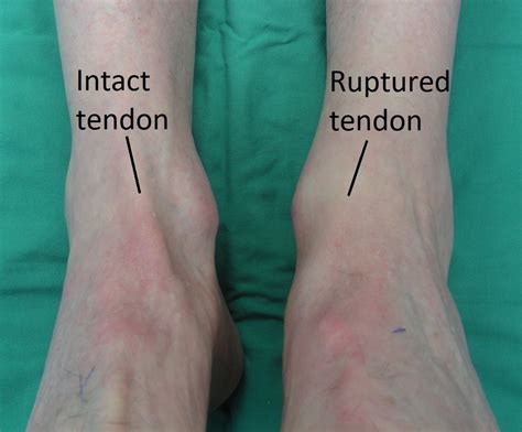 Tibialis Anterior Tendonitis Tendinopathy Symptoms Causes Treatment ...