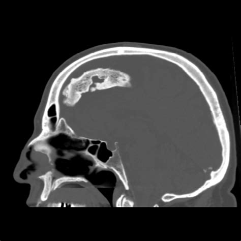 falx ossification | pacs