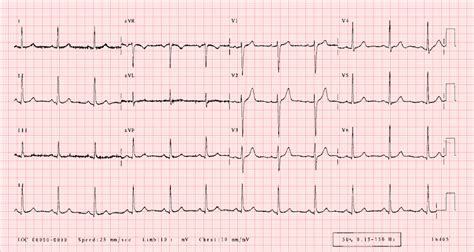 EKG' nin Yorumlanması | Resüsitasyon