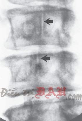 Lumbar Zygapophyseal Joint Injection - Pain Management