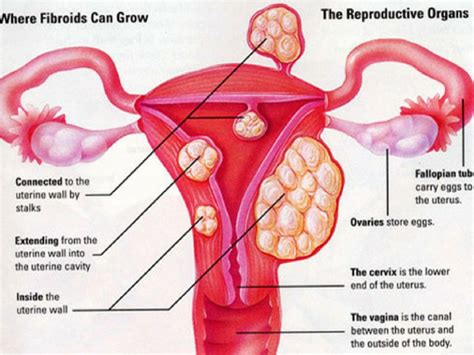 Ramai Wanita Tak Tahu Ada Cyst & Fibroid, Adakah Anda Berisiko? - Pesona Pengantin