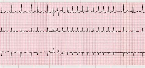 Fibrilación auricular, arritmia más común