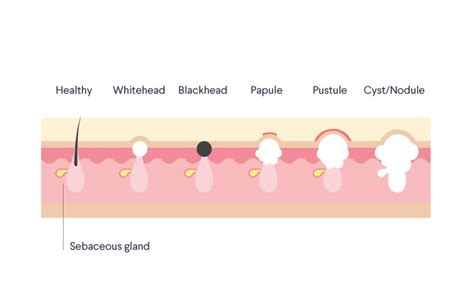 Types of acne: blackheads, whiteheads, fungal, cysts + more