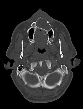 Odontogenic keratocyst | Radiology Case | Radiopaedia.org