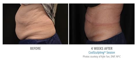 CoolSculpting before and after | Real Patient Photos - Vein & Laser Institute