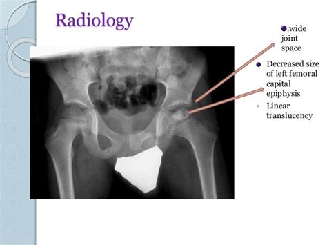 Legg calve perthes disease